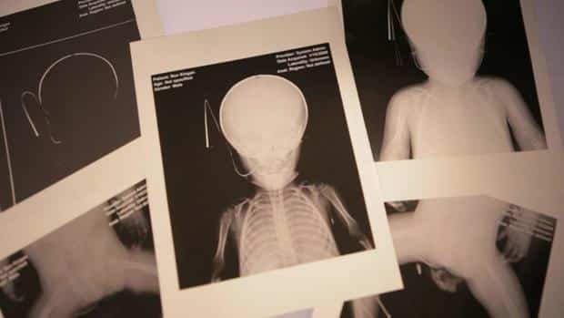 calusinski-cleanxrays.jpg 