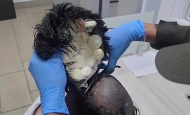 Man tried to smuggle bags of cocaine under “narco wig,” Colombian police say
