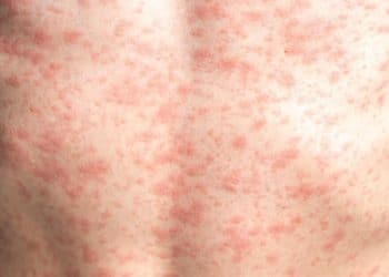 Child dies after contracting measles in Texas, officials say