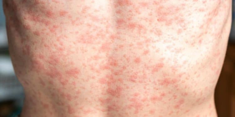 Child dies after contracting measles in Texas, officials say