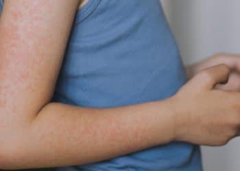 Measles alert in New Jersey, cases reported in several states