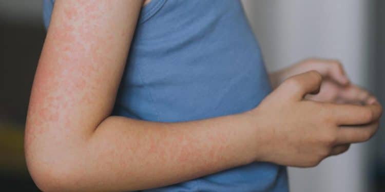 Measles alert in New Jersey, cases reported in several states