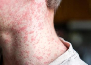 More measles cases reported in Texas