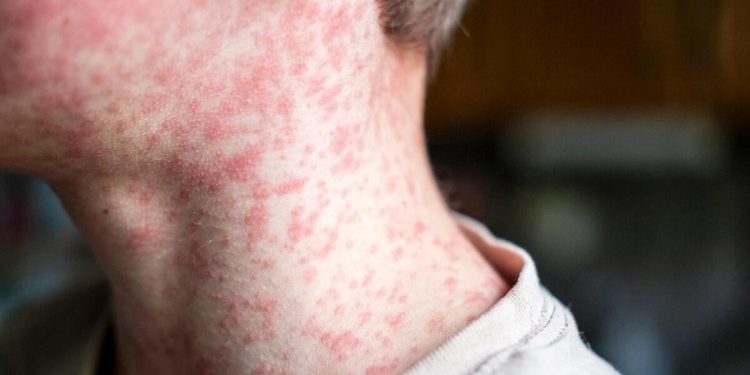 More measles cases reported in Texas