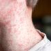 More measles cases reported in Texas