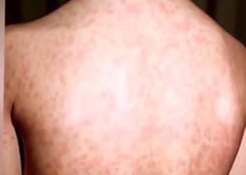 Texas measles outbreak grows