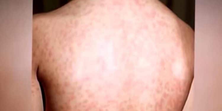 Texas measles outbreak grows