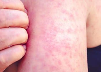 Texas measles outbreak nears 100 cases: “This is the tip of the iceberg”