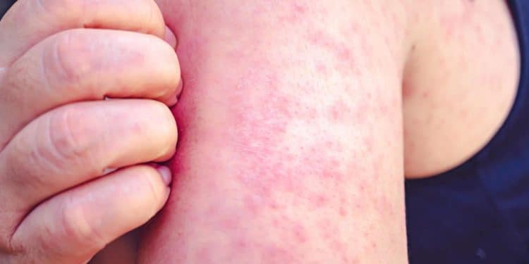 Texas measles outbreak nears 100 cases: “This is the tip of the iceberg”