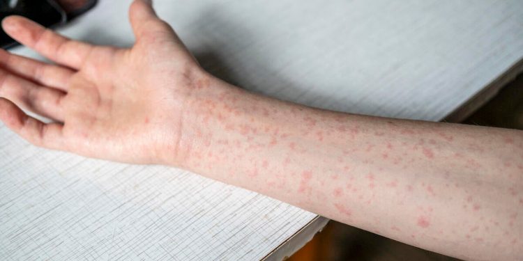 What we know about the measles death reported in Texas