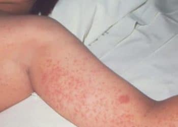 Measles outbreak in Texas rises to 48 cases and counting