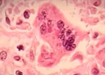 Texas measles outbreak grows to 159 cases