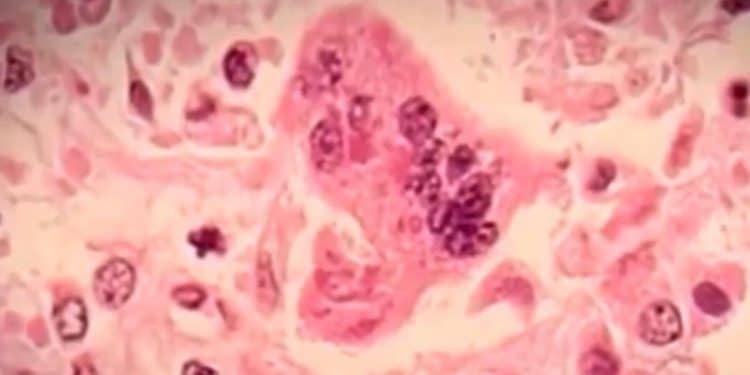 Texas measles outbreak grows to 159 cases